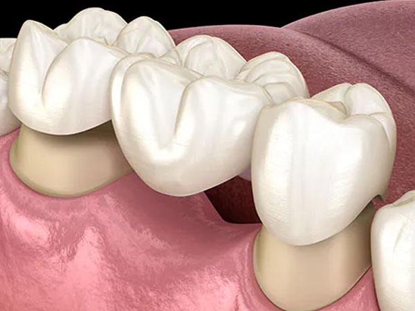 Dental Crown & Bridges adalah perawatan gigi restoratif yang bertujuan untuk memperbaiki gigi yang rusak/hilang. Crown (mahkota gigi) adalah tutup gigi permanen yang ditempatkan untuk mengembalikan bentuk, fungsi, dan penampilan gigi