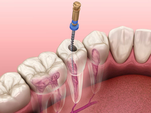 Root Canal Treatment (RCT) adalah prosedur medis yang dilakukan oleh dokter gigi untuk menyembuhkan infeksi atau kerusakan pada jaringan lunak di dalam gigi. Melalui pengangkatan pulpa gigi, pembersihan saluran akar, pengisian dan penutupan.