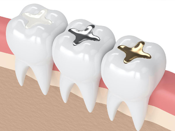 Filling gigi adalah prosedur medis yang dilakukan oleh dokter gigi untuk memperbaiki gigi yang rusak atau berlubang. Tindakan ini bertujuan untuk mengembalikan struktur gigi yang hilang akibat kerusakan dan mencegah masalah kesehatan gigi yang lebih serius.