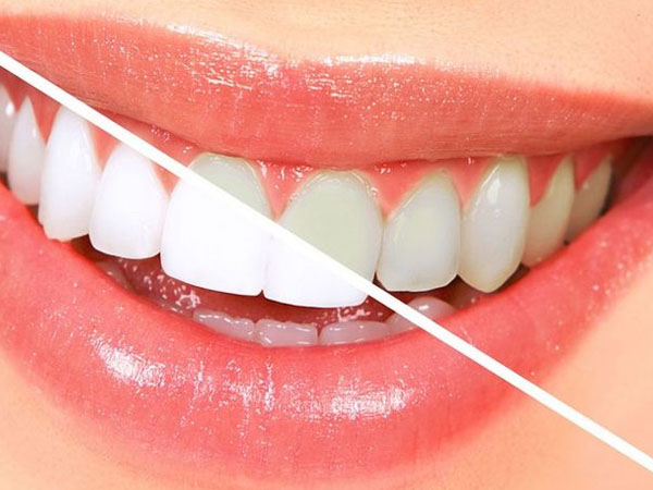 Bleaching atau pemutihan gigi adalah prosedur untuk memutihkan warna gigi yang terlihat kuning atau menguning karena berbagai alasan seperti faktor genetik, kebiasaan merokok, konsumsi minuman atau makanan berpigmen, atau penuaan.
